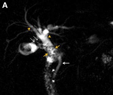 Mirizzi Syndrome Recognition On Magnetic Resonance
