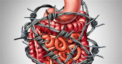 Irritable Bowel Syndrome Ibs Medinformer