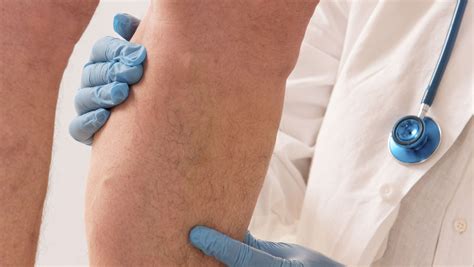 Get To Know What Chronic Venous Insufficiency Is And How To Help It