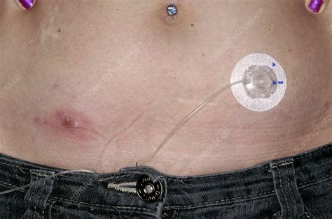 Abscess On The Abdomen Stock Image C0042390 Science Photo Library
