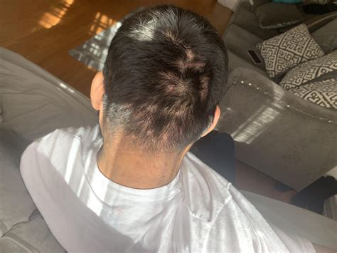 Bumps Back Of Head After Haircut Bump On Back Of Head