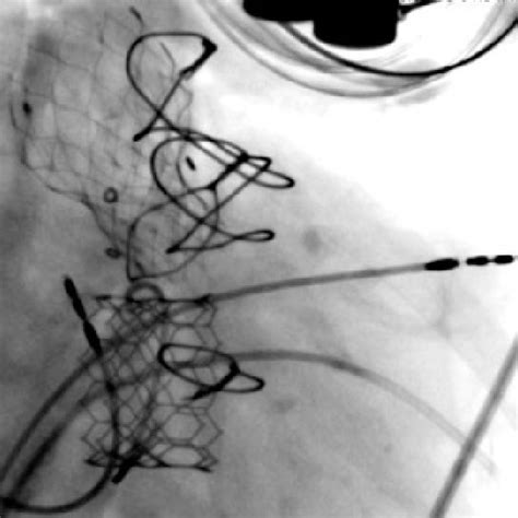 Pdf Transcatheter Tricuspid Valve In Ring And Aortic Valve In Valve