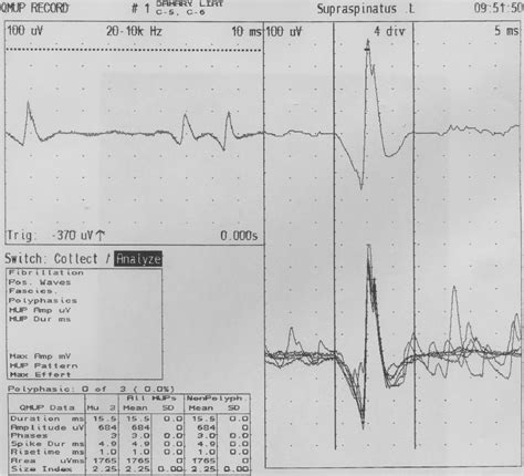 Figure 3 From Facial Nerve Paralysis And Partial Brachial Plexopathy