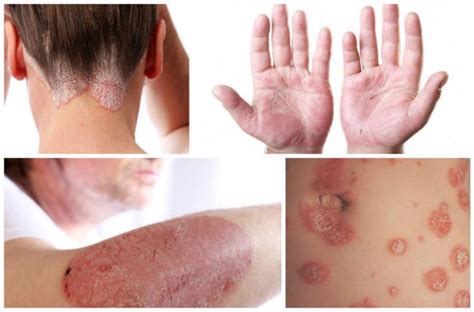 What Does Psoriasis Look Like 1 Symptoms And Pictures