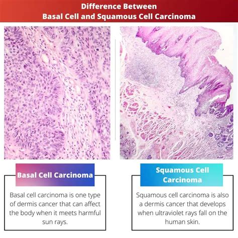 Basal Cell Vs Squamous Cell Carcinoma Difference And Comparison