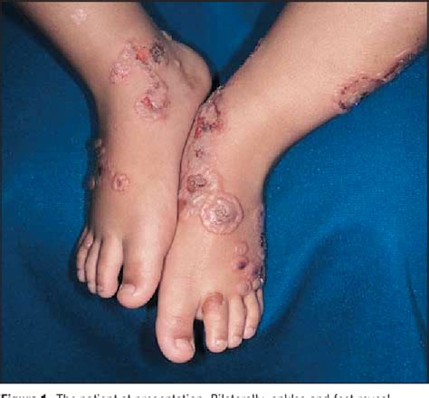 Figure 1 From Treatment Of Linear Iga Bullous Dermatosis Of Childhood