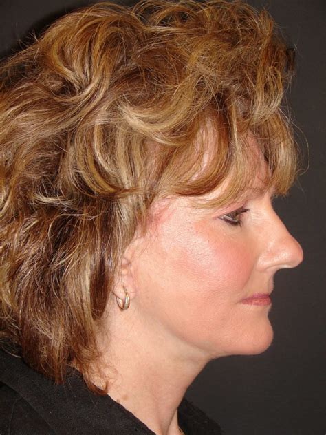Face And Neck Rancho Santa Margarita Ca Orange County Surgical Specialists