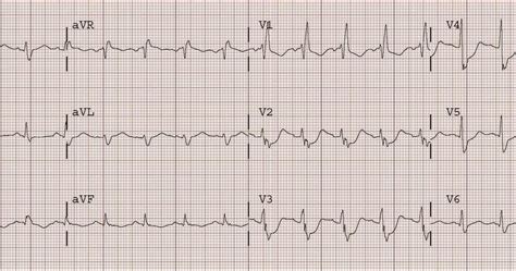 Dr Smiths Ecg Blog Posterior St Elevation Mi In The Setting Of Right