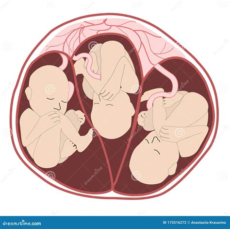Triplets In Utero From An Anterior Three Fetuses In The Uterus