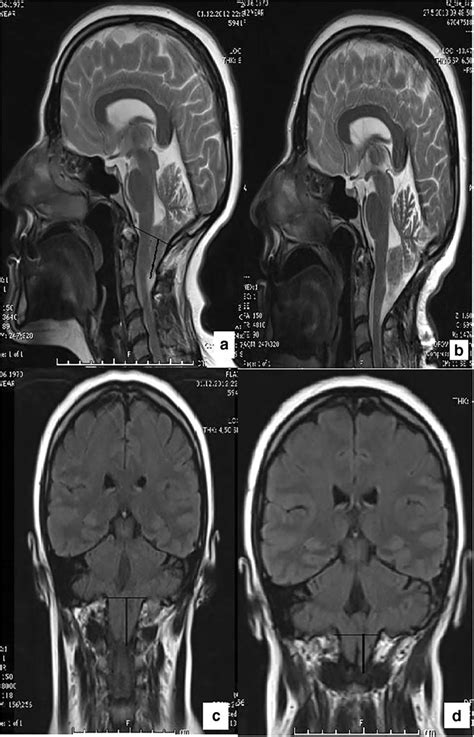 A 42 Year Old Diagnosed With Cm1 A C Preoperative Mri Showed A