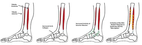 Shin Splints Medial Tibial Stress Syndrome Ankle Foot And Orthotic