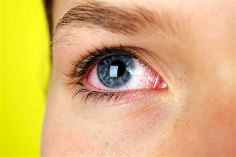 7 Silent Signs You Could Have Dry Eye Syndrome The Healthy