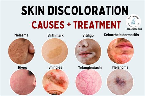 Skin Discoloration Causes Pictures And Treatment