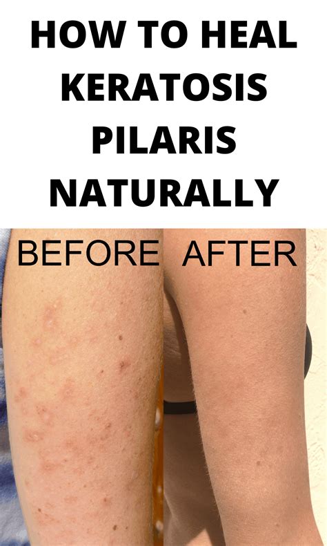 How To Heal Keratosis Pilaris Pilaris From The Inside Out Pure And
