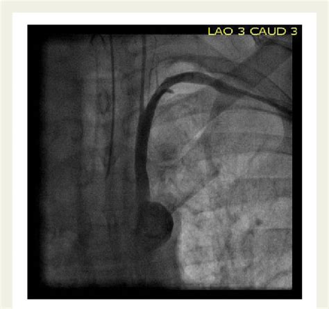 Angiogram Of Left Axillary Artery Into The Subclavian Download