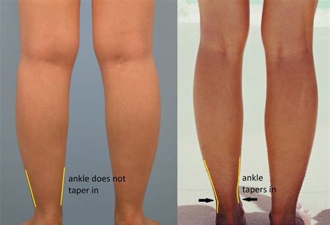 Dermasphere Kick Cankles To The Curb This Summer