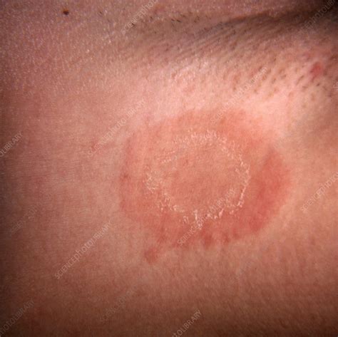 Ringworm Stock Image C0222115 Science Photo Library