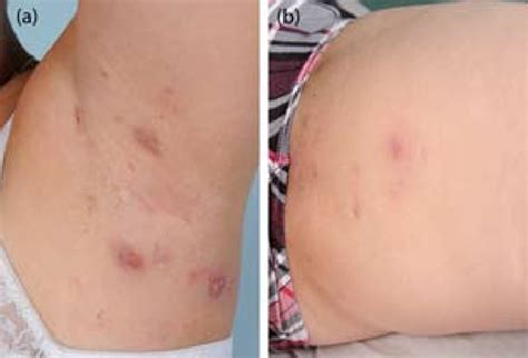 Nodules Folliculitis Cysts And Depressed Scars In The