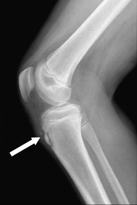 Lateral Radiograph Of The Knee Shows Soft Tissue Swelling And