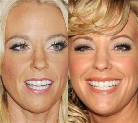 Facts About Kate Gosselin Plastic Surgery Rumors