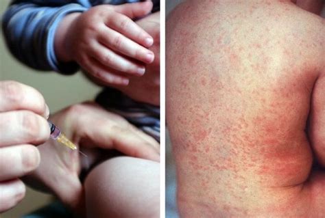 Huge Rise In Measles And Scarlet Fever Cases In Essex In 2018 Public