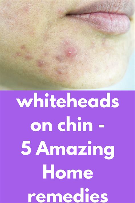 Whiteheads On Face Treatment At Home Doctor Heck