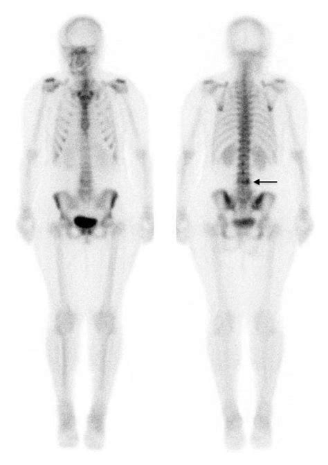 Spect Ct Scan Lumbar Spine Ct Scan Machine Kulturaupice