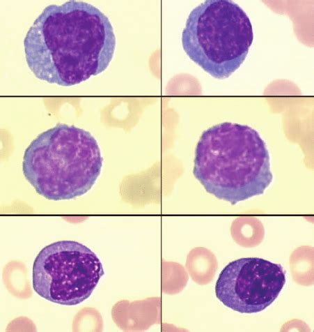 Circulating Plasma Cells In Peripheral Blood Cases And