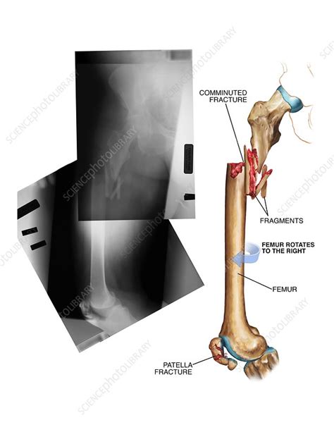 Comminuted Fracture Of The Femur Stock Image C0210800 Science