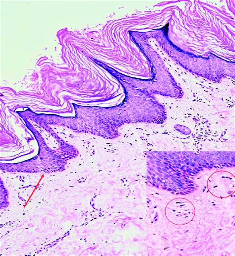 Skin Biopsy From Neck Showed Hyperkeratosis With Papillomatosis And