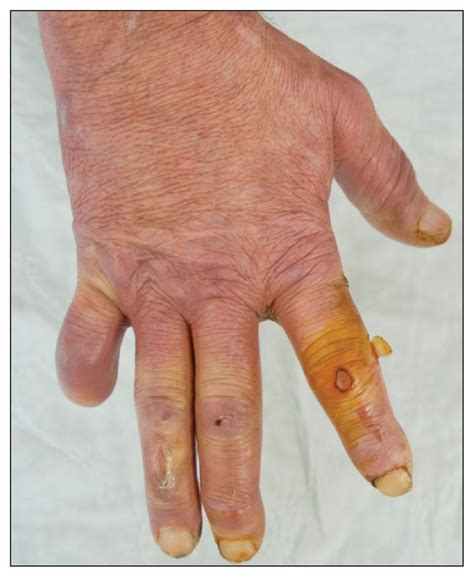 Arthritis Progressive Maculopapular Rash And Severe Peripheral