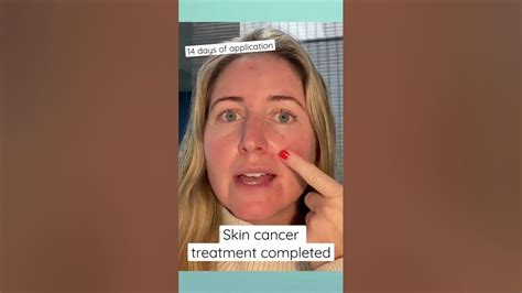 Skin Cancer Treatment Completed Youtube
