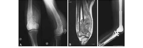Ac Distal Femur Reconstruction After Resection For Osteosarcoma In