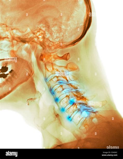 Arthritis Of The Neck X Ray Stock Photo Alamy