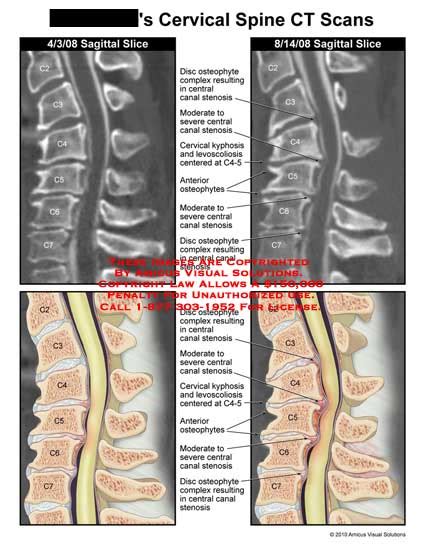 Amicus Illustration Of Amicus Injury Cervical Spine Ct Scans Disc