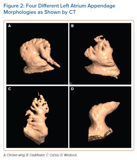 Four Different Left Atrium Appendage Morphologies As Shown By Ct