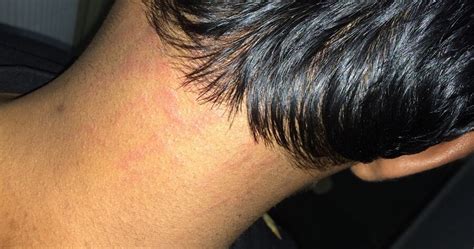 Harsha And Sanjay Salon — Got A Rash On My Neck After Haircut