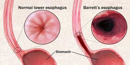 Barrett S Esophagus Causes And Treatment Assignment Point