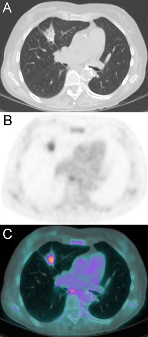 Axial Ct A Axial Pet B And Axial Fused Petct C Images Show A