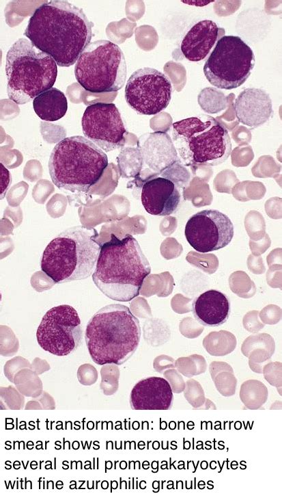 Pathology Outlines Primary Myelofibrosis