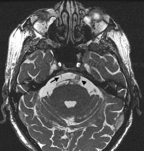 Figure 2 From An Unusual Case Of Binocular Oblique Diplopia In An 82