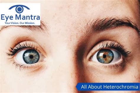 Heterochromia Types Causes Diagnosis Remedies And Treatment