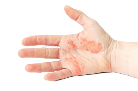 Hand Eczema Stock Photo Image Of Eczema Health Flaking 89006284