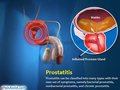 Prostatitistreatmenttypesdietcausessymptomsdiagnosis