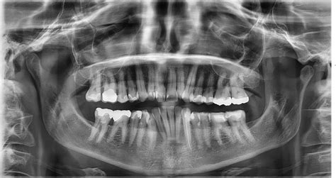 Ask The Dentist What Are Dental X Rays And Are They Safe Capstone