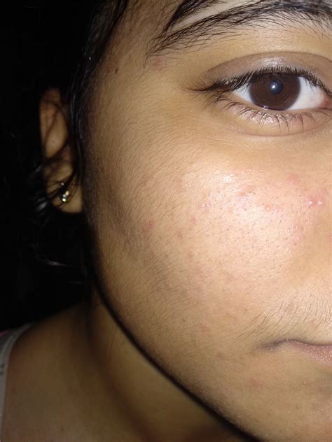 Red Small Pimples And Weird Bumps On My Face Please Help General My