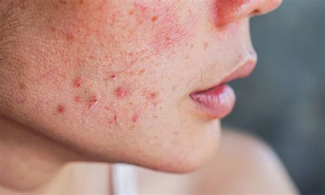 Rosacea Guide Causes Triggers And Treatment Software