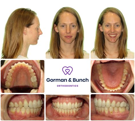 Invisalign Before And After Stories With Our Patients Gorman And