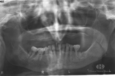 Osteonecrosis De Los Maxilares Por Bifosfonatos Clínica Dental Borrás