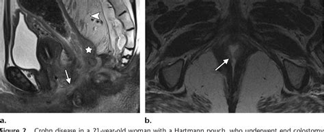 Figure From Imaging And Surgical Management Of Anorectal Vaginal Fistulas Semantic Scholar
